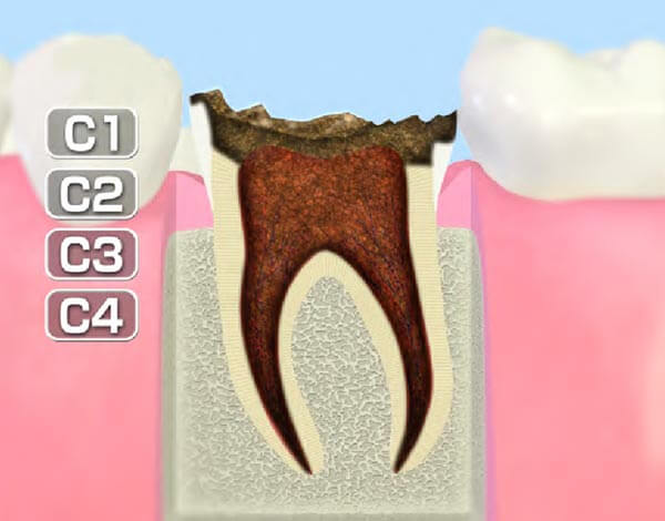 歯質が失われた歯(C4)